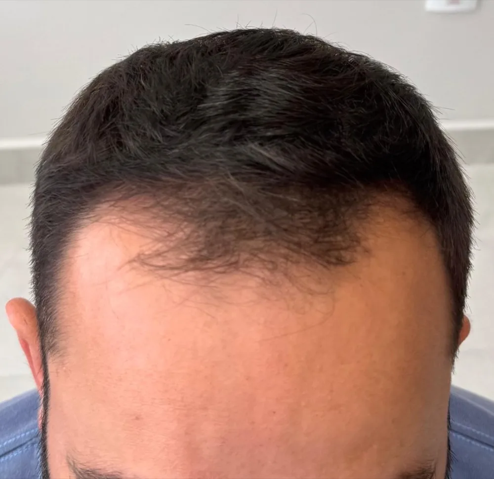 Antes do transplante capilar: entradas e linha frontal com rarefação
