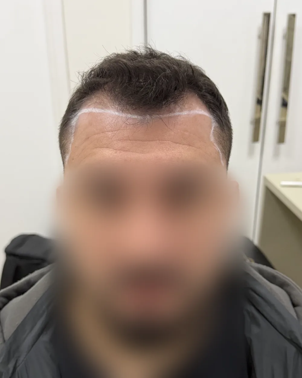 Antes do transplante capilar: entradas profundas e linha frontal alta, com a marcação do desenho pré-operatório